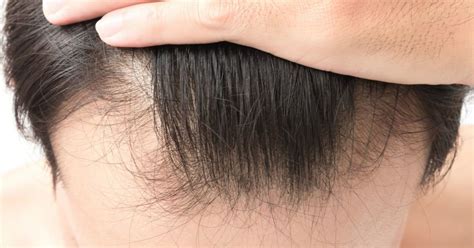 Hair Loss Treatments For Guys Who Want To Keep Their Thinning Hair Stop