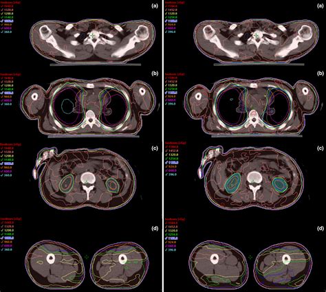 Automatic Treatment Planning For VMATbased Total Body Irradiation