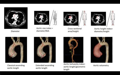 Aortic… The American Association For Thoracic Surgery Aats