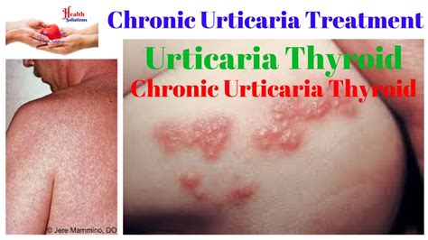 Chronic Urticaria Treatment Urticaria Thyroid Chronic Urticaria Thyroid 😀 Youtube