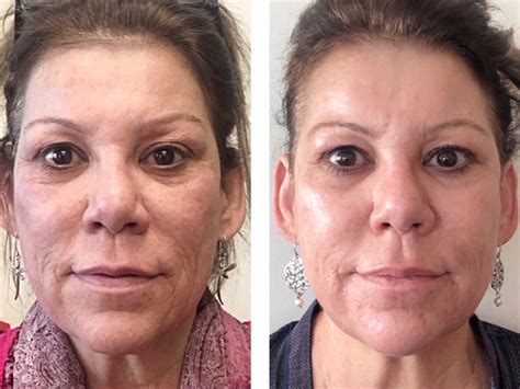 Scarlet Rf Microneedling Integrative Aesthetics