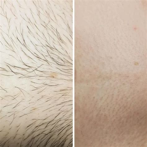 Bikini Laser Hair Removal Cosmetic Tattoo Studio