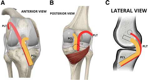 Nonanatomic Posterolateral Tenodesis for Posterior Ligament