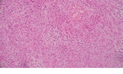 Figure From Primary Pleural Epithelioid Hemangioendothelioma