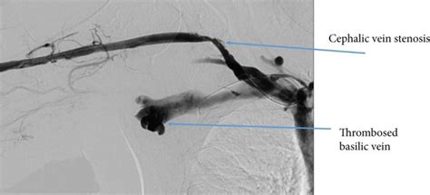 Outflow Obstruction—cephalic Vein Stenosis And Basilic Vein Thrombosis Download Scientific