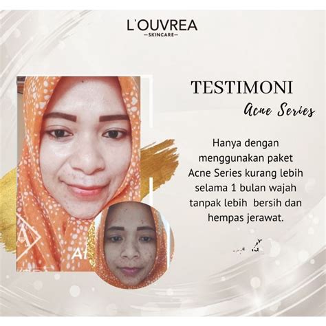 Jual Toner Acne Ampuh Louvrea Skincare Untuk Menghilangkan Jerawat Dan