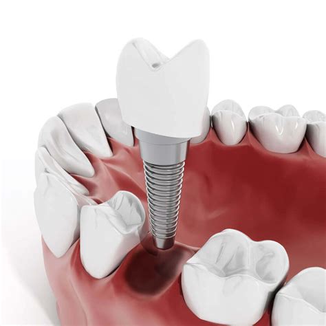 Cirugía de implantes dentales cuidados y postoperatorio