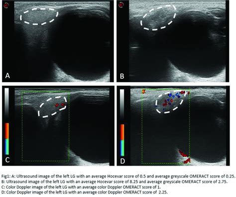 Ab0822 Lacrimal Gland Ultrasound Demonstrates Good Interobserver