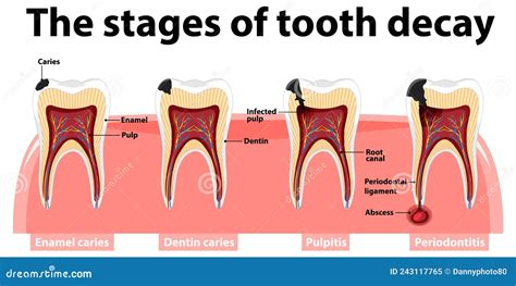 The Stages Of Tooth Decay Infographic. Dental Toothache Symbol Vector Illustration ...