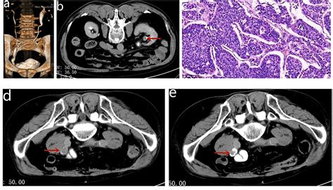 Frontiers Case Report A Case Of Neoadjuvant Immunotherapy In