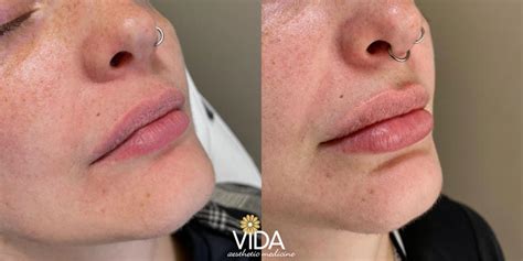 Injectables Photos VIDA Aesthetic Medicine Salem Oregon