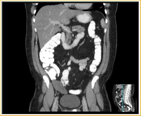 Appendiceal Mucocele Ct Sumers Radiology Blog