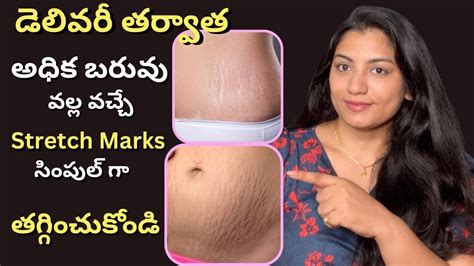 stretch marks   remove stretch marks