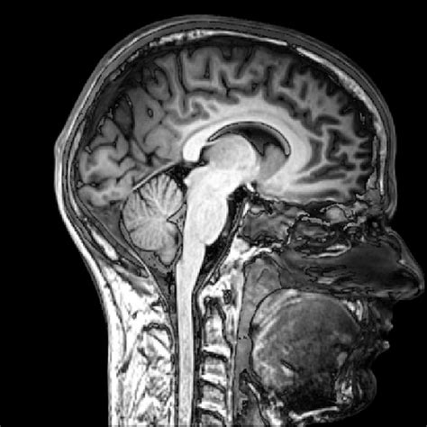 Closing In to an MRI Diagnose for Autism