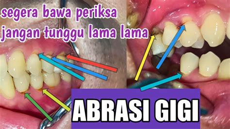 Segera Bawa Ke Dokter Gigi Jika Gigimu Seperti Ini Jangan Tunggu Lama