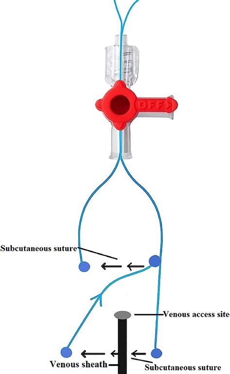 Combining A ‘Z’ Suture with a Stopcock Assembly for Pediatric Femoral
