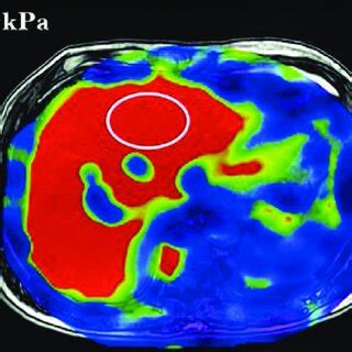 Magnetic Resonance Mr Elastography Stiffness Map Is Fused On An