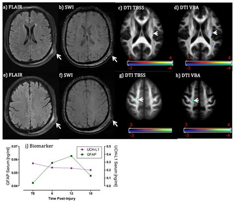 Case 2 MRI And Biomarker Profile In A Patient With Traumatic Axonal