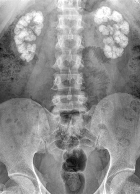 Medullary Nephrocalcinosis Plain Film Sumers Radiology Blog