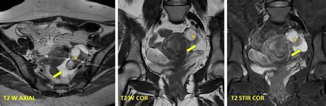 Inclusion Cyst