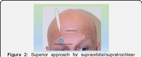 Figure 1 From Supraorbitalsupratrochlear Nerve Blocks Clinical