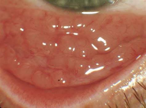 Malignant Lymphoma Of The Conjunctiva Survey Of Ophthalmology