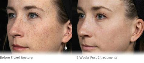 Fraxel Skin Resurfacing Laser Treatment Cranley Clinic London