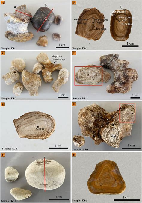 Macroscopic Images Of The Kidney Stones And Their Cross Sections A The