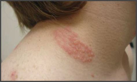 Shingles on neck pictures | Shingles Expert