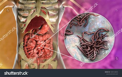 Parasite Worms In Humans
