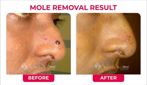 Mole Removal Surgery Mole Removal Treatment Sakhiya Skin Clinic