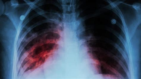 Scarring Of The Lungs And Pulmonary Fibrosis Lung Institute