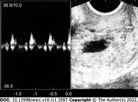 Figure 1 From Ultrasound Guided Local Ethanol Injection For Fertility