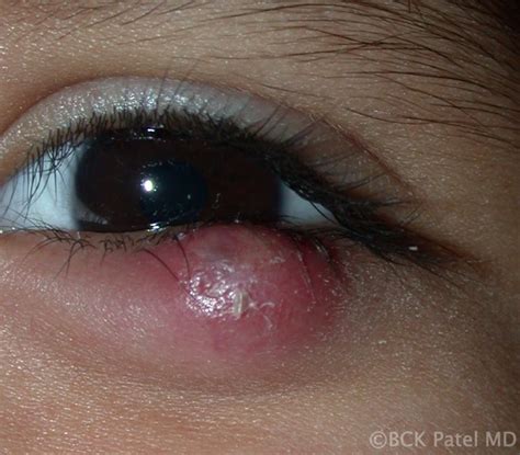 Moran Core What Are The Differences Between A Stye A Chalazion An