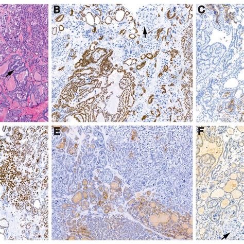 Case 1 A Routine He Stained Section Of Papillary Thyroid Carcinoma