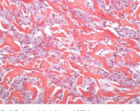 Figure From Juvenile Psammomatoid Ossifying Fibroma With Skull Base