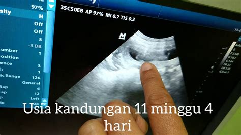 USG KEHAMILAN USIA KANDUNGAN 11 MINGGU YouTube