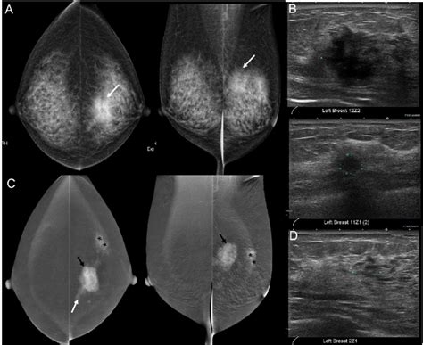 42 Year Woman With Palpable Left Breast Lump A Standard Mammogram