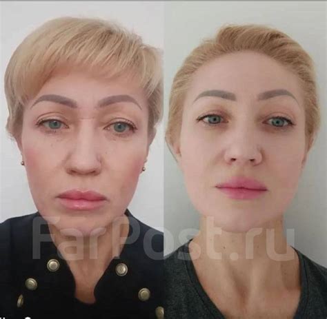 Биоревитализация. Акция! Коктейль Монако 7500 во Владивостоке