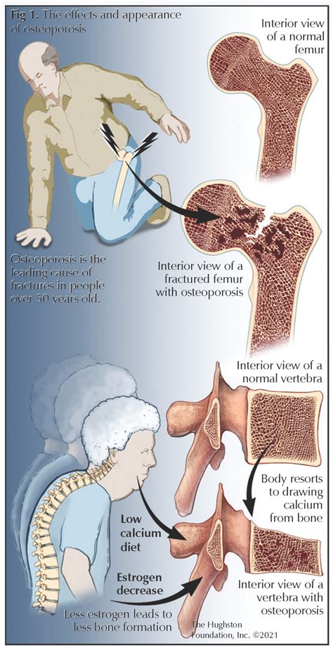 Osteoporosis Hughston Clinic