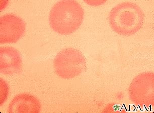 Blood smear Information | Mount Sinai - New York