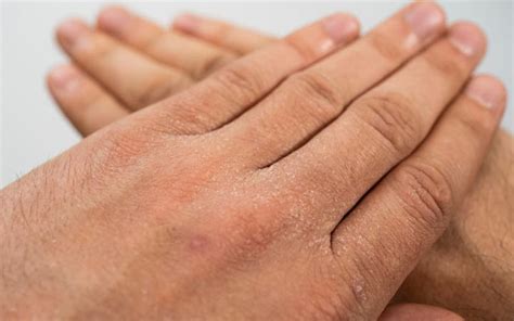 What Is Exfoliative Dermatitis And How Does It Look Causes And Ways To Treat