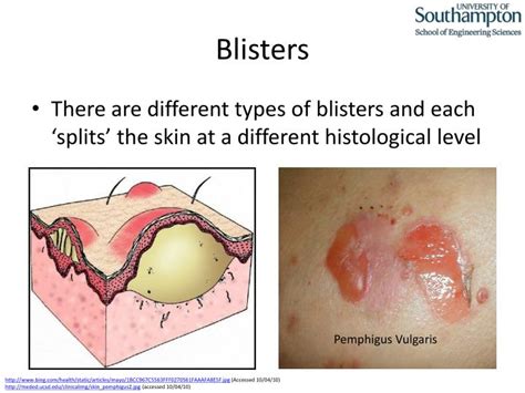 PPT - Some Aspects of Skin Tribology : Friction Blister PowerPoint ...