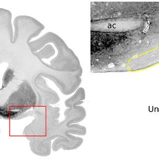 (PDF) The Piriform Cortex and Human Focal Epilepsy