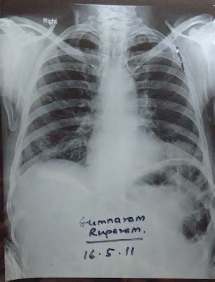 Air Under Diaphragm Cxr / Imaging Case of the Week 79 | Emergucate ...