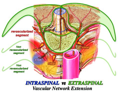 Intra Vs Extraspinal Arterial Network Extension Spinal Cord Perfusion