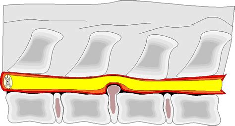 Intervertebral Disc Disease | Safari Veterinary in League City, TX