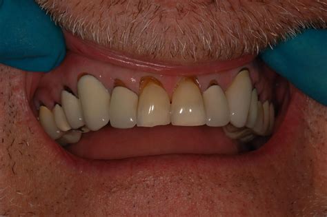 mouth breather long   tooth common dental phrases