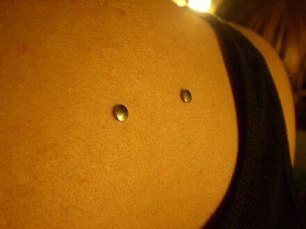 Transdermal implant - Wikipedia