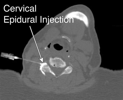 Epidural Steroid Injection Larkin Health